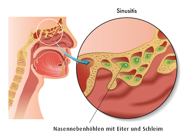 Nebenhöhlen