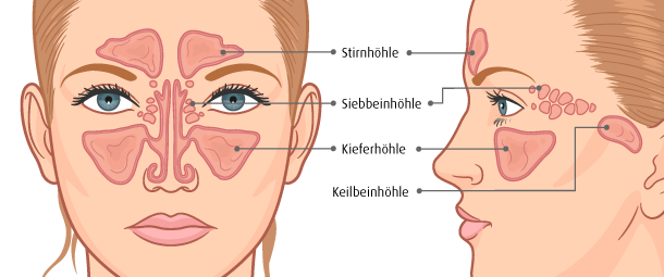 Die besten Hausmittel bei Stirnhöhlenentzündung (Sinusitis)