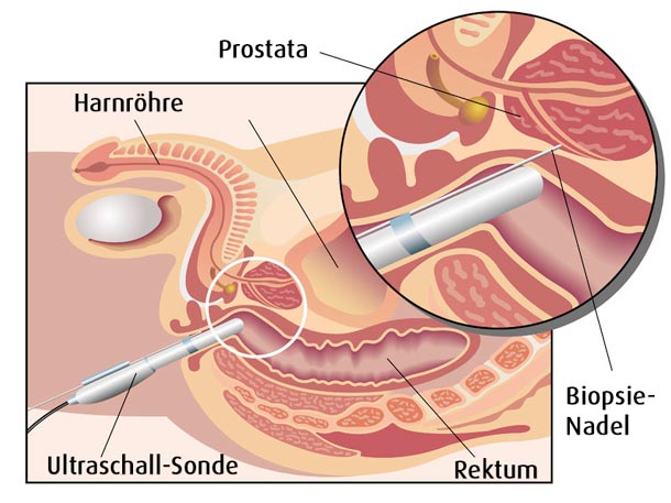 Prostata Biopsie